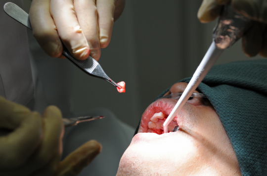 dental implants in Melbourne